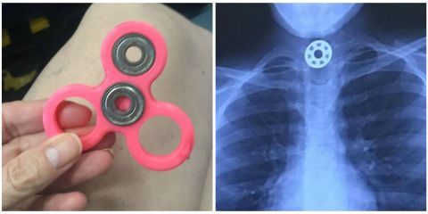 Mom Warns Parents After Her Daughter Reportedly Choked on a Fidget Spinner Mom Warns Parents After Her Daughter Reportedly Choked on a Fidget Spinner