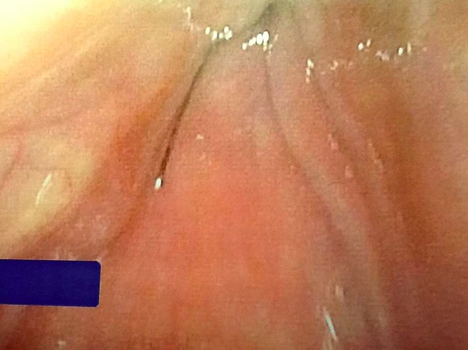 This Man's Terrifying Warning About Grill Brushes Just Went Viral Why