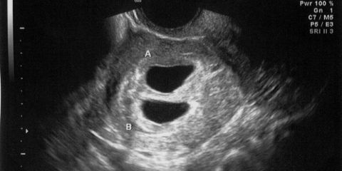 This Surrogate Mother Became Pregnant While Carrying A Baby For Another Couple forecasting This Surrogate Mother Became Pregnant While Carrying A Baby For Another Couple advise